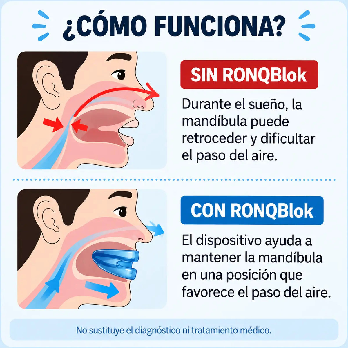 Ronqblok Placa Anti Ronquidos